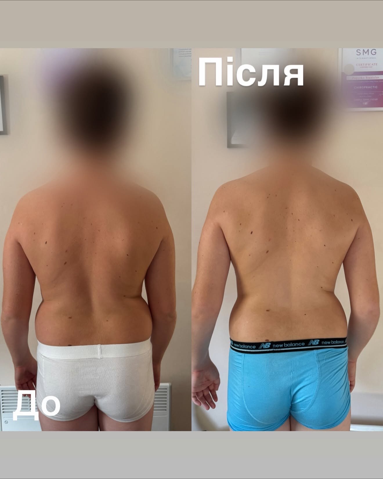 Корекція постави — до і після